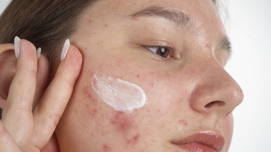 Akne kod tinejdžera