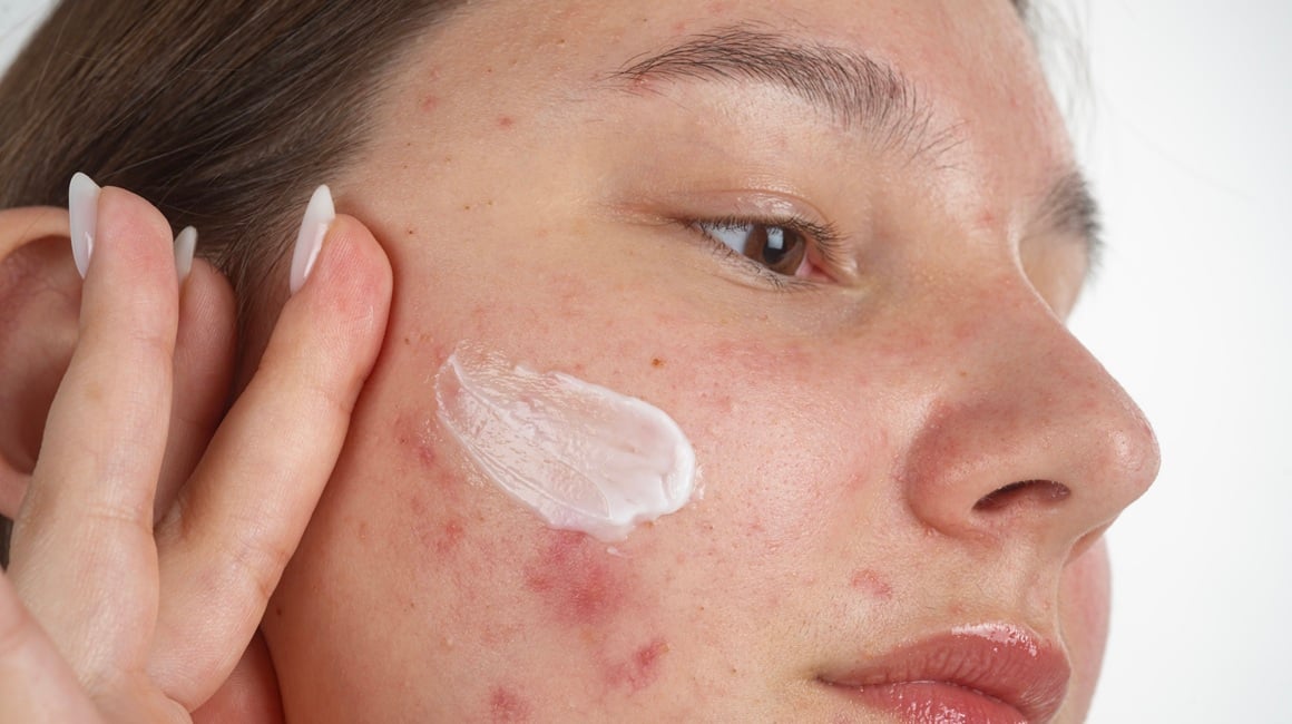 Akne kod tinejdžera