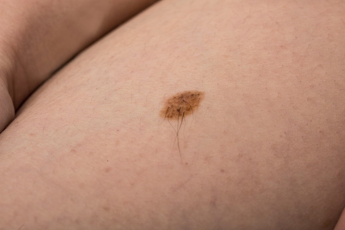 Ako iz madeža raste dlačica, to obično znači da se ispod njega nalazi aktivan folikul dlake