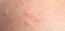 Alergeni iz okoliša poput peludi, plijesni ili grinja iz prašine mogu pogoršati simptome atopijskog dermatitisa