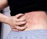 Atopijski dermatitis, najčešći oblik ekcema, može uzrokovati izrazito neugodan svrbež i upalu kože