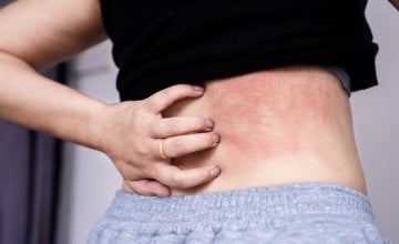 Atopijski dermatitis, najčešći oblik ekcema, može uzrokovati izrazito neugodan svrbež i upalu kože