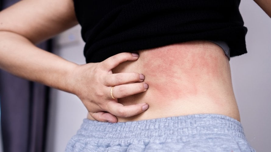 Atopijski dermatitis, najčešći oblik ekcema, može uzrokovati izrazito neugodan svrbež i upalu kože