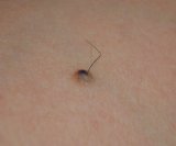 Dlačice koje rastu iz madeža često izazivaju zabrinutost, ali u većini slučajeva riječ je o potpuno normalnoj pojavi