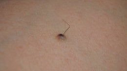 Dlačice koje rastu iz madeža često izazivaju zabrinutost, ali u većini slučajeva riječ je o potpuno normalnoj pojavi