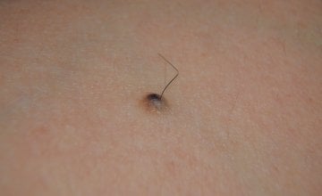 Dlačice koje rastu iz madeža često izazivaju zabrinutost, ali u većini slučajeva riječ je o potpuno normalnoj pojavi