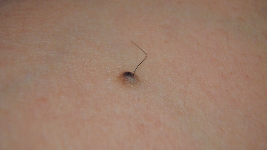 Dlačice koje rastu iz madeža često izazivaju zabrinutost, ali u većini slučajeva riječ je o potpuno normalnoj pojavi