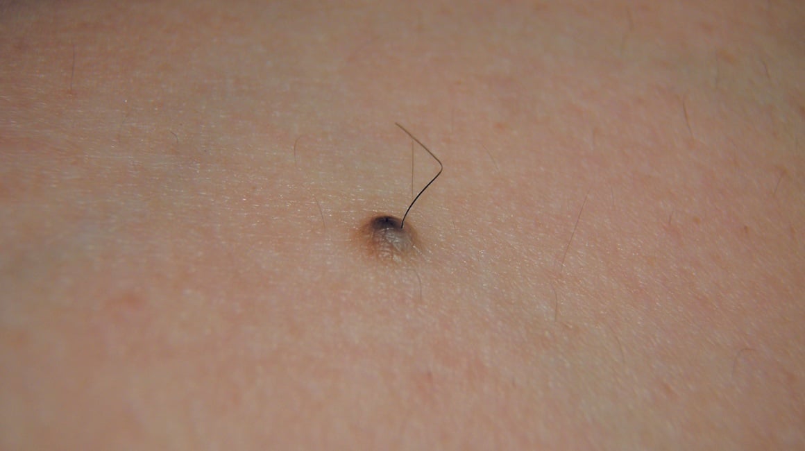 Dlačice koje rastu iz madeža često izazivaju zabrinutost, ali u većini slučajeva riječ je o potpuno normalnoj pojavi