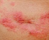 Herpes zoster ispod grudi
