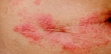 Herpes zoster ispod grudi