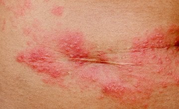 Herpes zoster ispod grudi