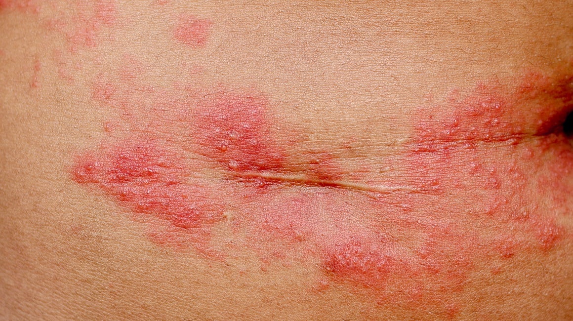 Herpes zoster ispod grudi
