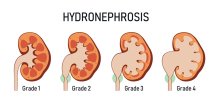Hidronefroza bubrega - stupnjevi