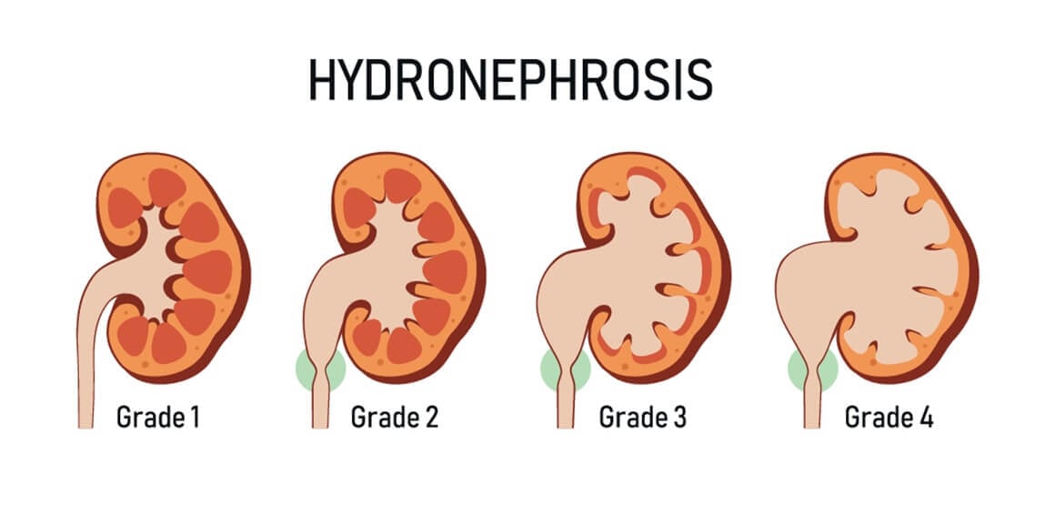 Hidronefroza bubrega - stupnjevi