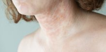 Iako stres ne uzrokuje atopijski dermatitis, može pogoršati simptome