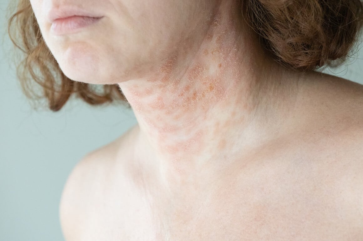Iako stres ne uzrokuje atopijski dermatitis, može pogoršati simptome