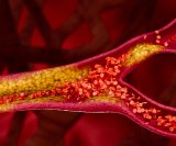 Kolesterol sudjeluje u izgradnji stanica i proizvodnji hormona, no kada ga u krvi ima previše, može se taložiti u stijenkama arterija