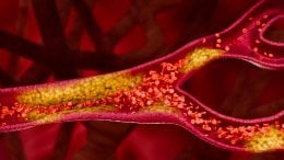 Kolesterol sudjeluje u izgradnji stanica i proizvodnji hormona, no kada ga u krvi ima previše, može se taložiti u stijenkama arterija