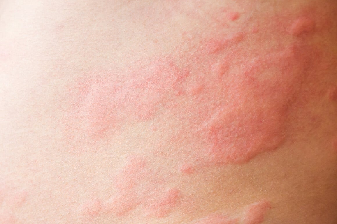 Kronična spontana urtikarija dugotrajno je stanje kože koje se očituje uzdignutim promjenama na koži - koprivnjačama - koje svrbe