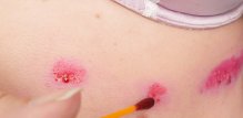 Liječenje herpes zostera ispod grudi