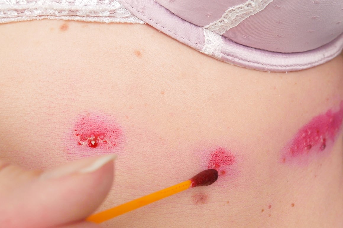 Liječenje herpes zostera ispod grudi