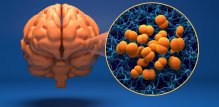 Meningitis B je ozbiljna bakterijska infekcija koju uzrokuje bakterija Neisseria meningitidis skupine B