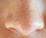 Miteseri (crne točkice na koži) nastaju kada se u folikulu dlake nakupe sebum (prirodno ulje kože), mrtve stanice kože i bakterije povezane s aknama