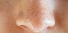 Miteseri (crne točkice na koži) nastaju kada se u folikulu dlake nakupe sebum (prirodno ulje kože), mrtve stanice kože i bakterije povezane s aknama