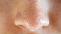 Miteseri (crne točkice na koži) nastaju kada se u folikulu dlake nakupe sebum (prirodno ulje kože), mrtve stanice kože i bakterije povezane s aknama