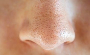 Miteseri (crne točkice na koži) nastaju kada se u folikulu dlake nakupe sebum (prirodno ulje kože), mrtve stanice kože i bakterije povezane s aknama