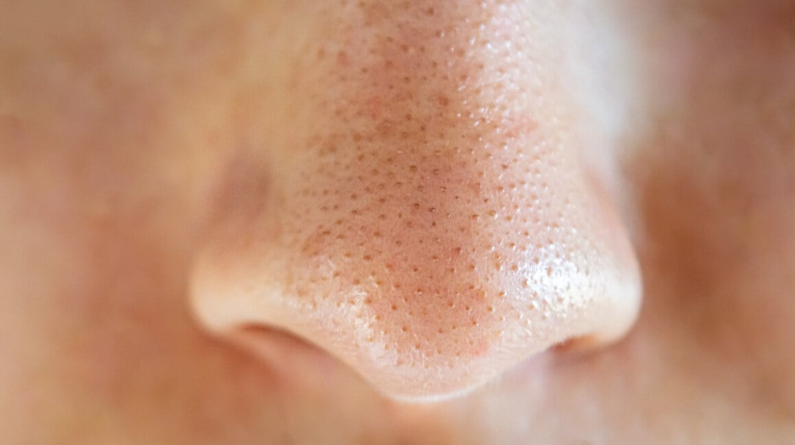 Miteseri (crne točkice na koži) nastaju kada se u folikulu dlake nakupe sebum (prirodno ulje kože), mrtve stanice kože i bakterije povezane s aknama