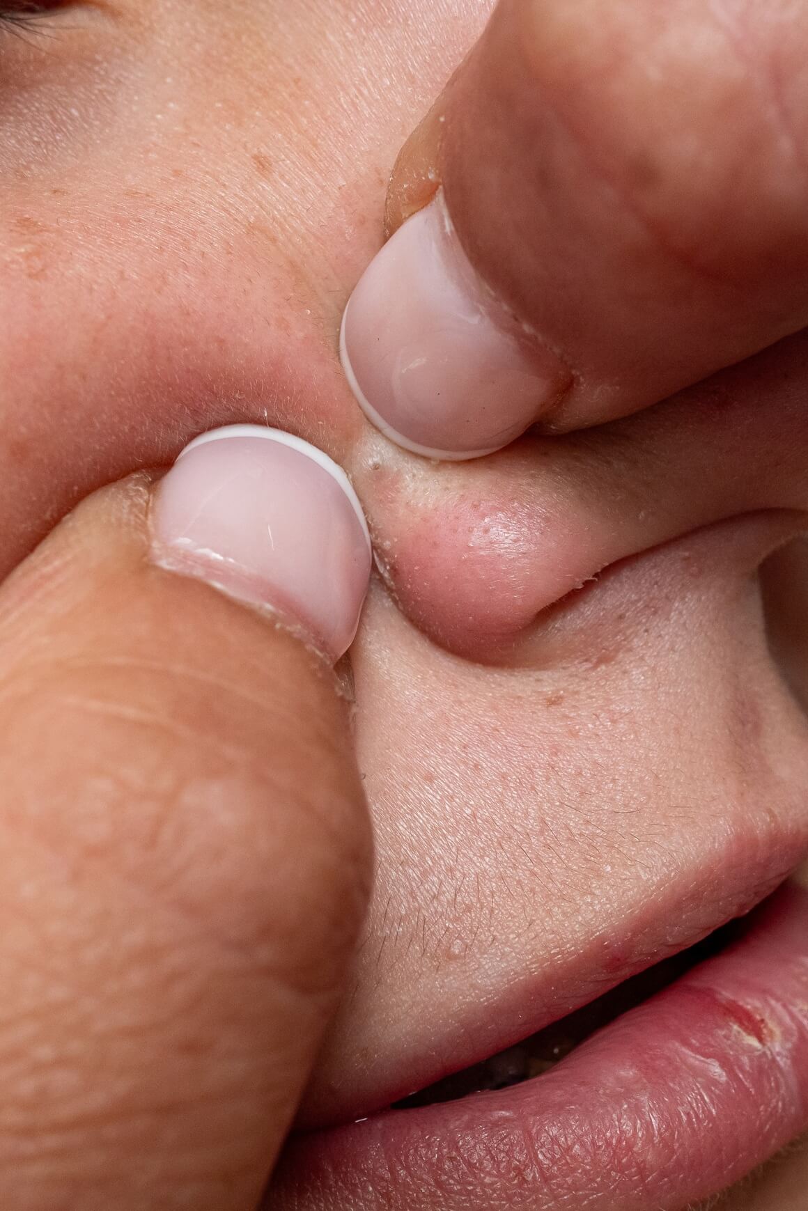 Najgore metode za uklanjanje mitesera