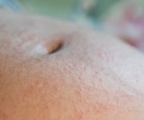 Papilarni dermatitis u trudnoći