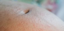 Papilarni dermatitis u trudnoći