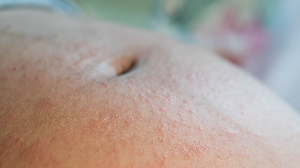 Papilarni dermatitis u trudnoći