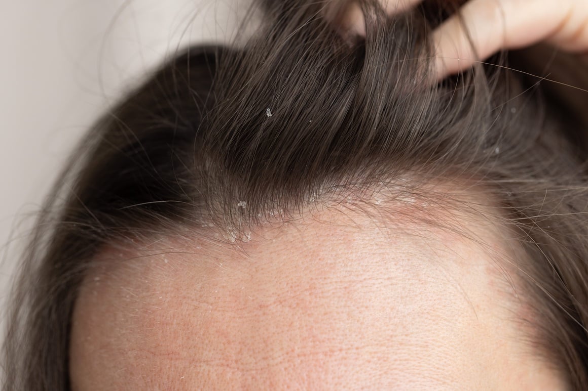 Perut se očituje kao sitne bijele ili žućkaste ljuskice na vlasištu, kosi ili odjeći, često praćene svrbežom