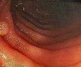 Peutz-Jeghersov sindrom