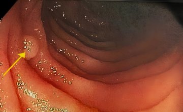 Peutz-Jeghersov sindrom