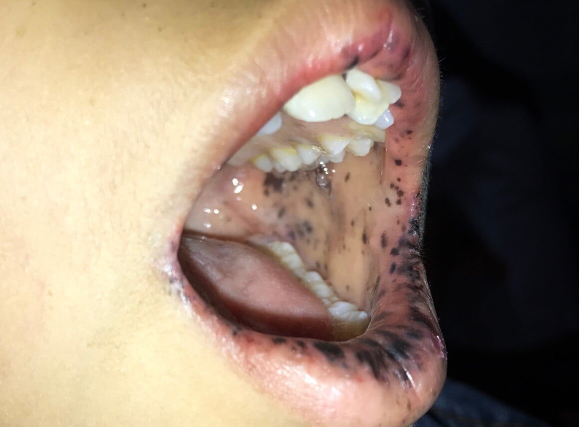 Peutz-Jeghersov sindrom - simptomi