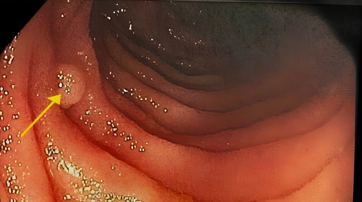 Peutz-Jeghersov sindrom