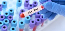 Povišen PSA povećava vjerojatnost raka, ali ne znači automatski dijagnozu