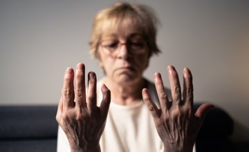 Reumatoidni artritis i životni vijek