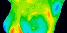 Termografija mjeri temperaturne razlike u tkivu dojke