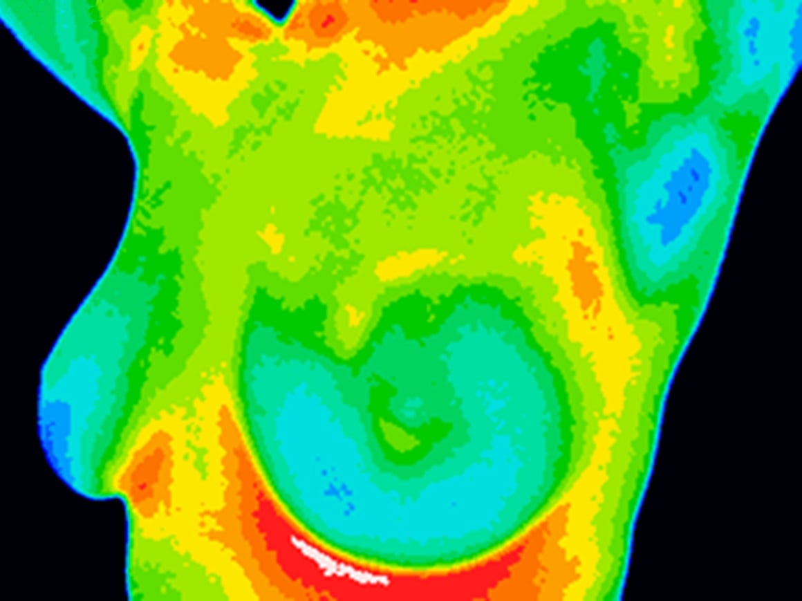 Termografija mjeri temperaturne razlike u tkivu dojke