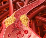 Visoki kolesterol često se otkrije tek nakon rutinske krvne pretrage