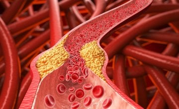 Visoki kolesterol često se otkrije tek nakon rutinske krvne pretrage