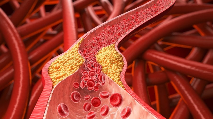 Visoki kolesterol često se otkrije tek nakon rutinske krvne pretrage