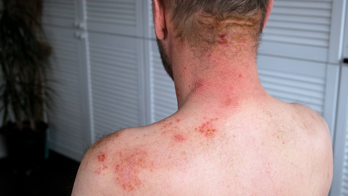 Zbog same bolesti i terapije koja potiskuje imunološki sustav osobe s reumatoidnim artritisom sklonije su infekcijama