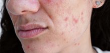 akne na licu kod tinejdžera