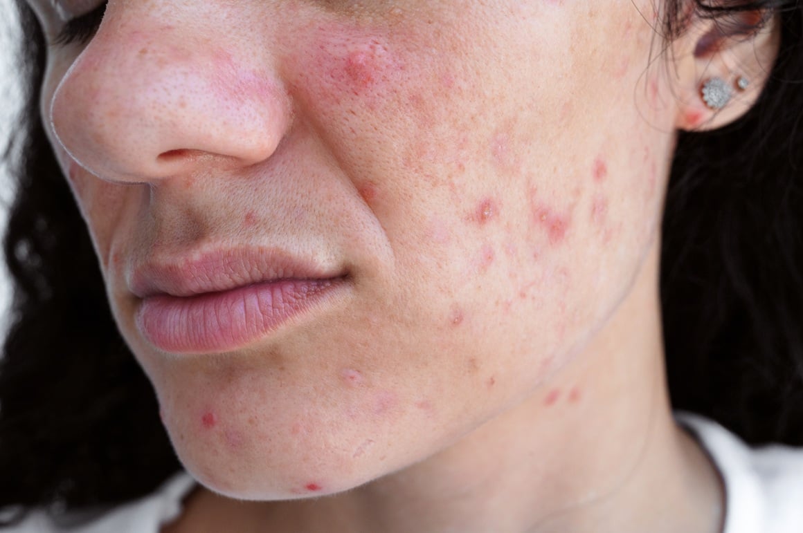 akne na licu kod tinejdžera